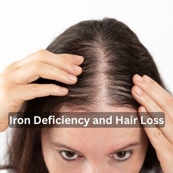 Iron Deficiency and Hair Loss
